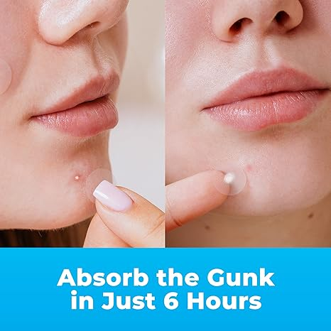Absorb the Gunk in Just 6 Hours - before and after pimple patch